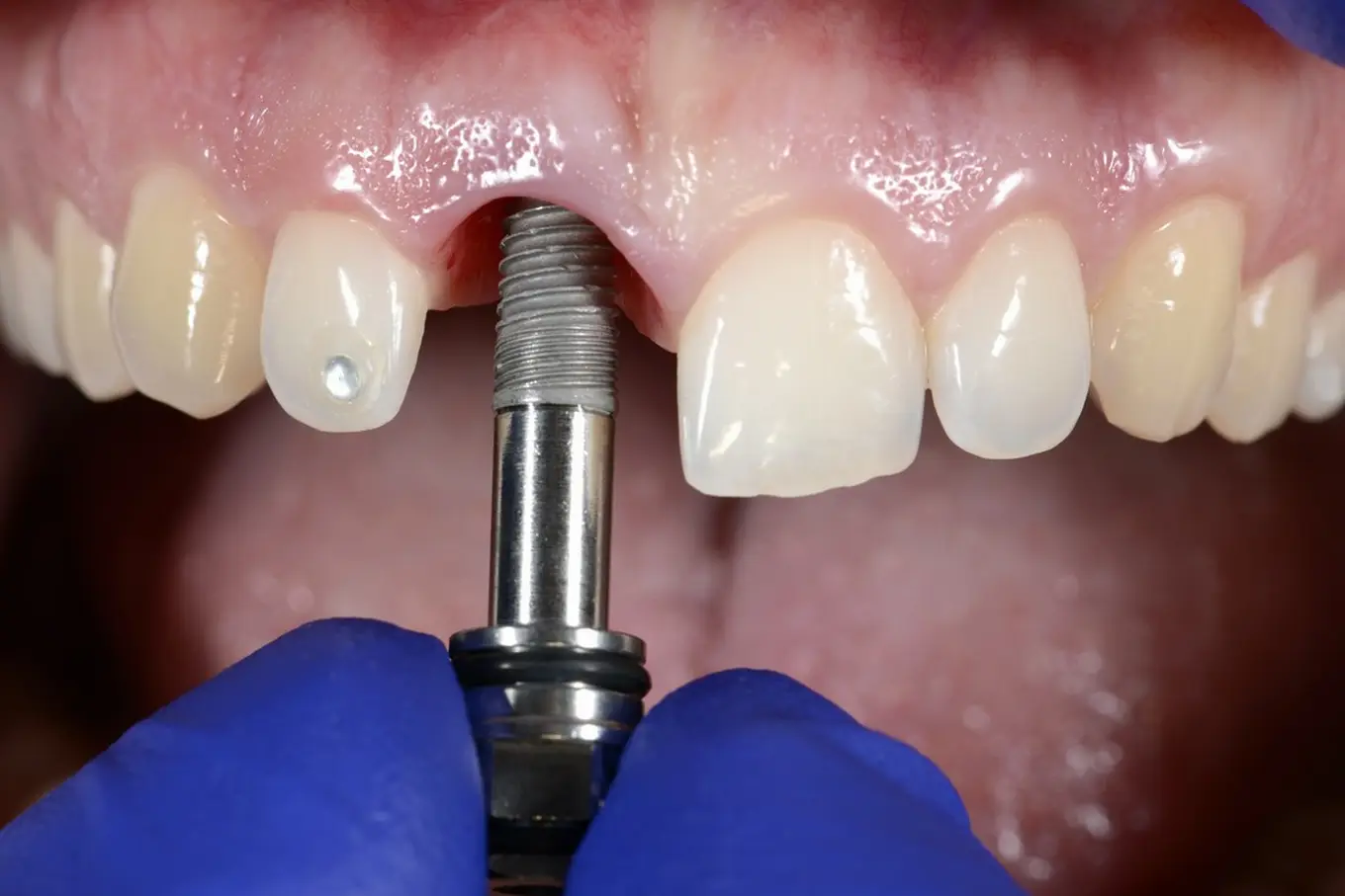 zabieg wszczepienia implantu dentystycznego